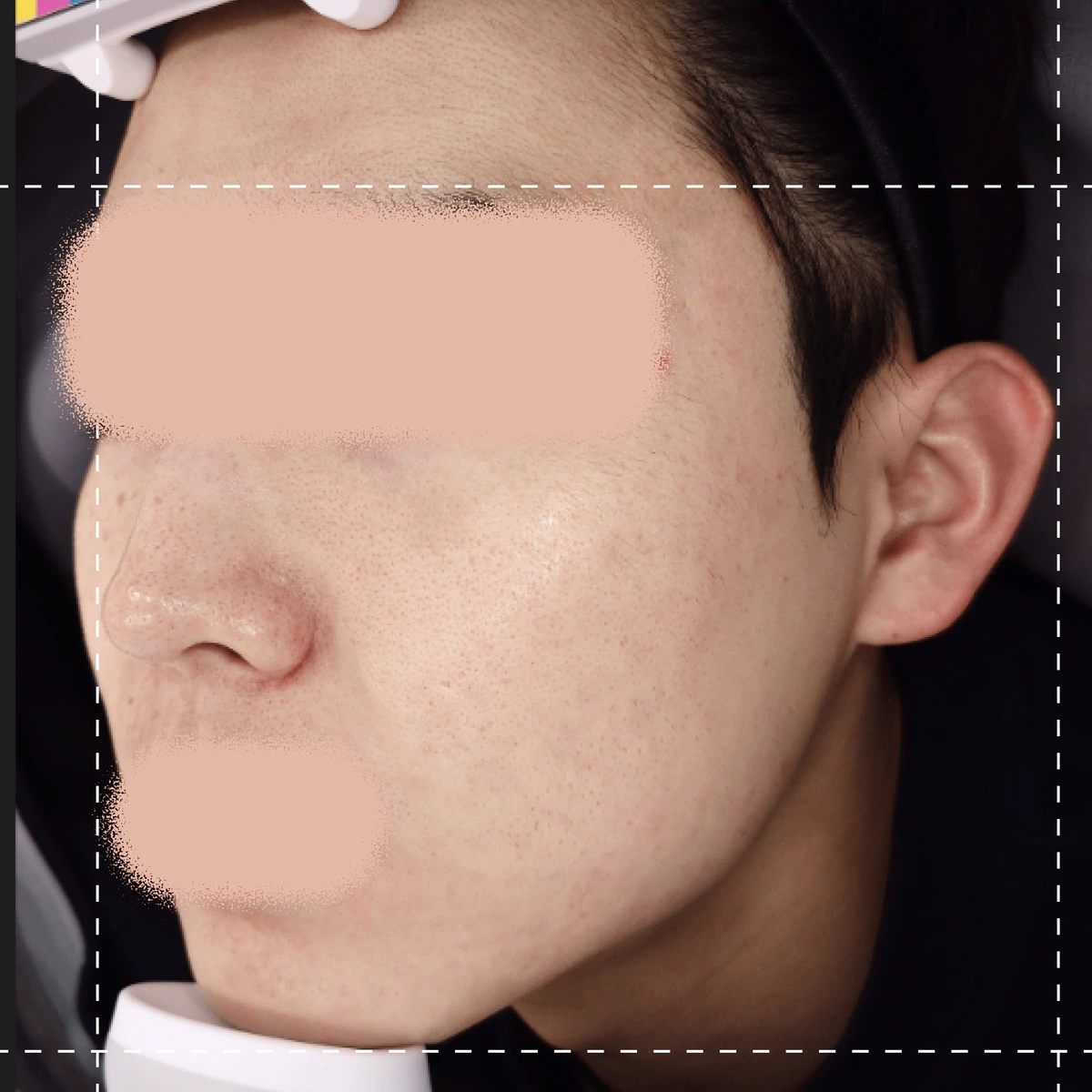 여드름테라피 시술 후 사진