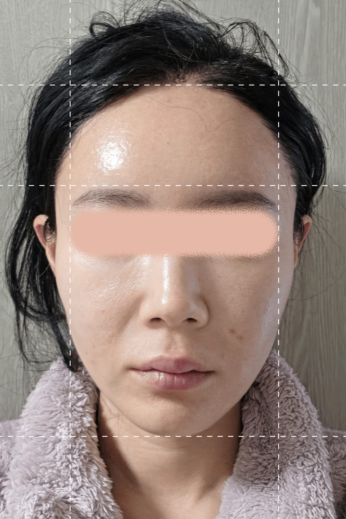 실스컬핑 시술 직전 사진