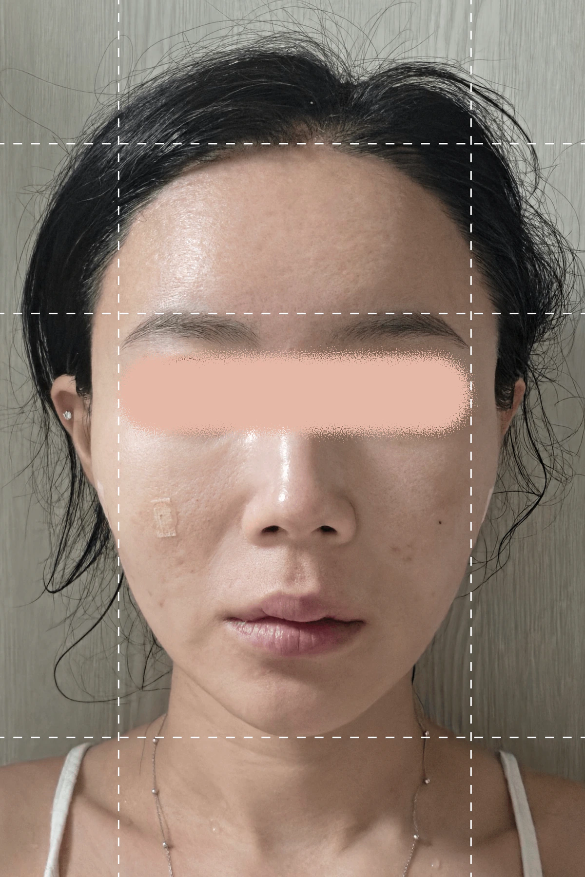 실스컬핑 시술 1주일 후 사진