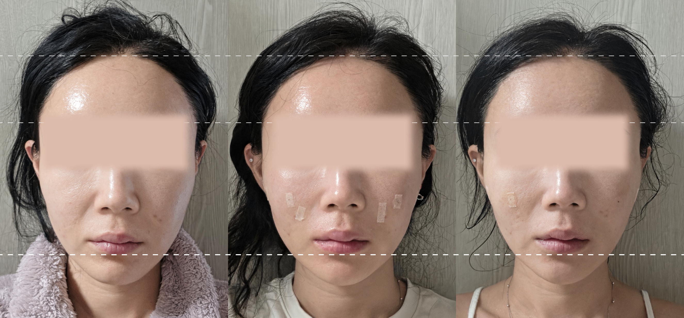 실스컬핑 전후 사진
